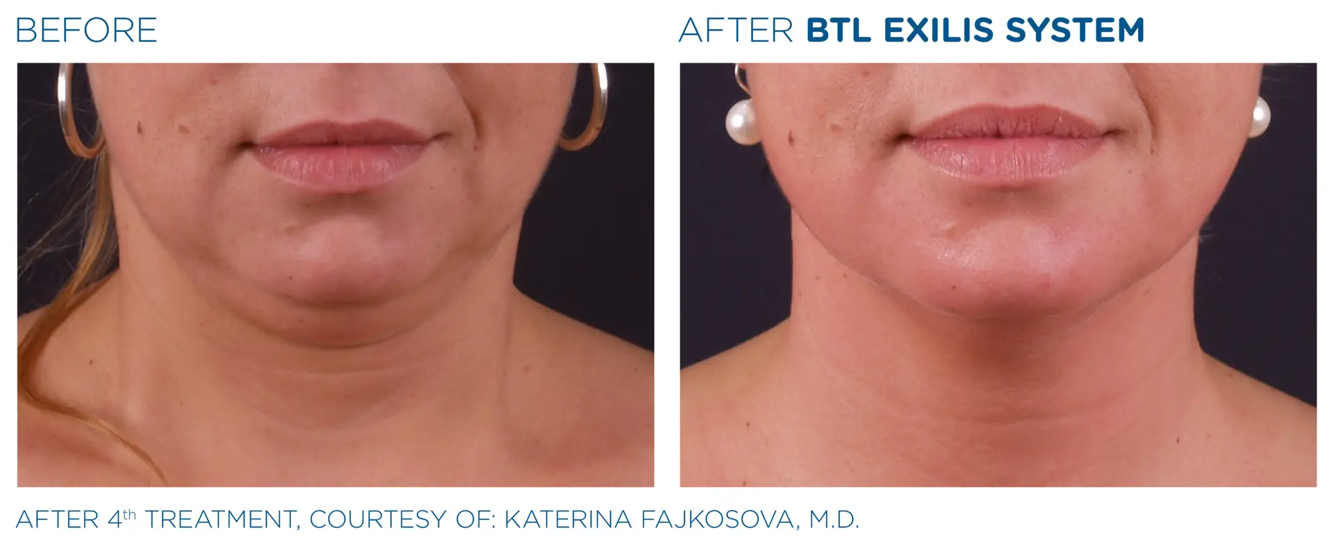 Skin Tightening - The Bespoke Clinic Newcastle
