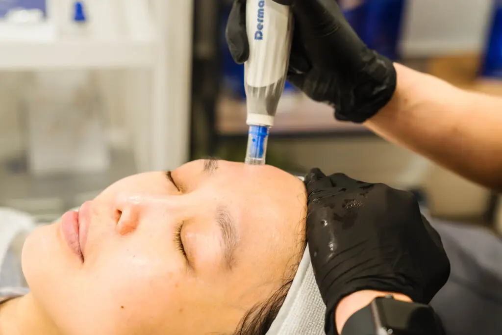 Cl ose-up of a practitioner in black gloves using a dermapen device on a woman's forehead during a facial treatment.
